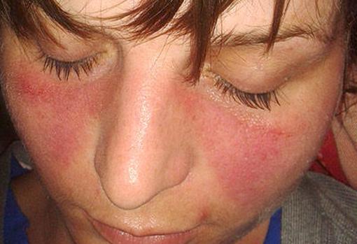 Paciente con lupus