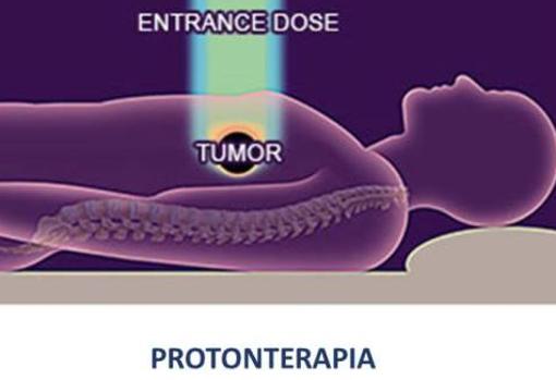 La radiación de protones afecta solo al turmor, reduciendo el riesgo de daño en el tejido sano