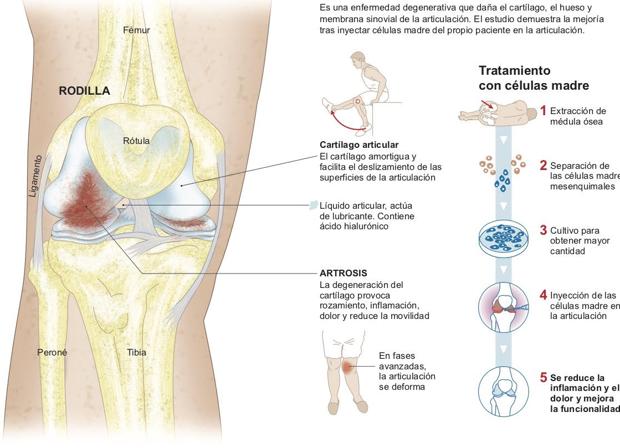Artrosis de rodilla. CUN.